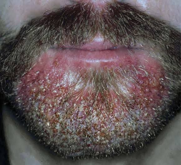 Tratamento de Barba