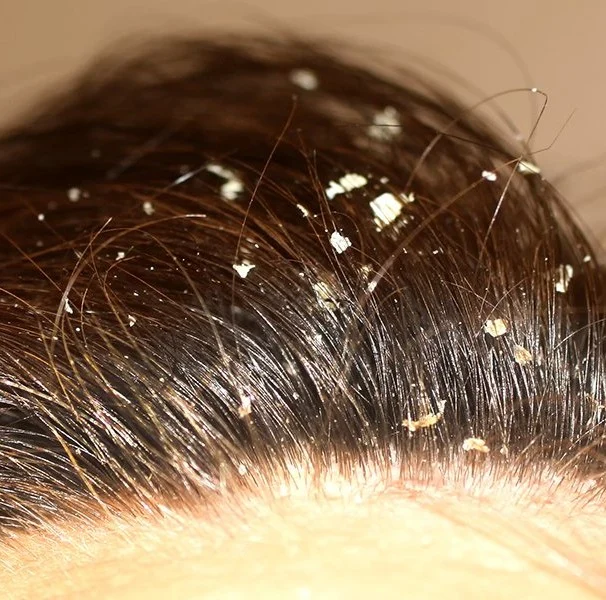 Tratamento para Dermatite Seborreica