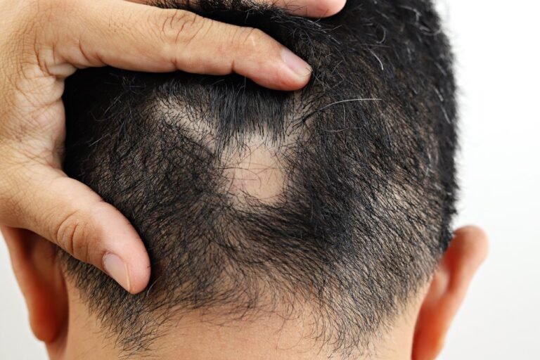 Tratamento para todos os tipos de Alopecia