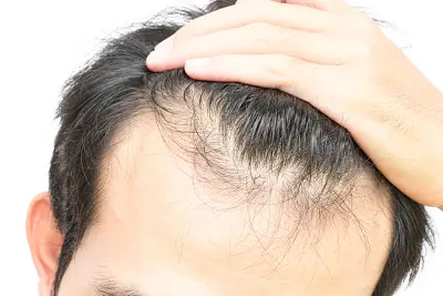 Tricologia Masculina