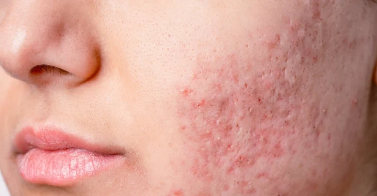 Cicatriz de Acne