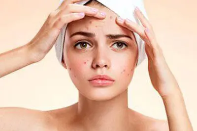 Acne e Espinhas