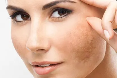 Melasma