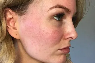 Rosacea