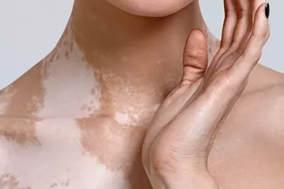 Vitiligo